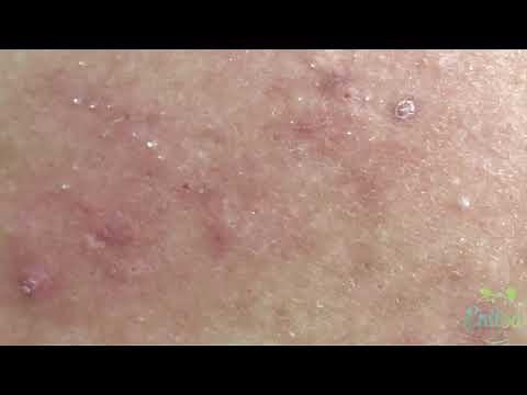 Extractions Of Blackheads Treatment On The Back / Christian