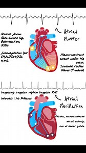 Atrial Flutter vs. Atrial Fibrillation: ECG Guide ⚡📈 🔁 Atrial Flutter · Rhythm: Regular · Atrial Waves: Sawtooth “F” waves · Rate: 250–350 bpm · P-Waves: Absent, replaced by flutter waves · Key: “Organized chaos” 📉 Atrial Fibrillation · Rhythm: Irregularly irregular · Atrial Waves: Erratic, low-amplitude “f” waves · Rate: 350–600 bpm · P-Waves: Absent · Key: “Disorganized chaos” 💡· Both rhythms often coexist and may transition within the same atrial substrate. · Management: Rate control (bet