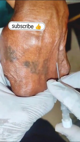 24G Yellow Cannula Insertion 💉 | Perfect Blood Flashback 🩸 #Shorts #viral #youtubeshorts