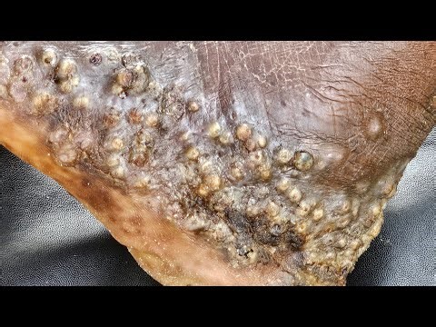 Ericsson Jigger King #10 - subscribe @riseupsociety.net ($9.99) for long vid & 1000+ nice jig vids