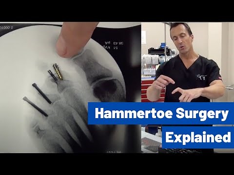 Hammertoe Correction Surgery Explained by Dr. Moore | (Using the Phalinx Hammertoe Fixation System)