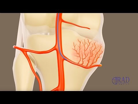 Genicular Artery Embolization for Osteoarthritis