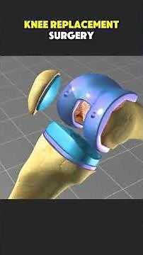 Total Knee Replacement Surgery: Step-by-Step 3D Animation #kneereplacementsurgery#kneesurgery