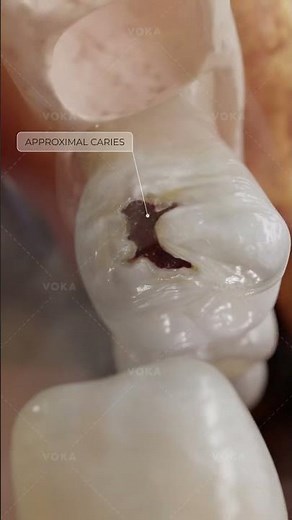 Qu’est-ce que les caries de classe 2 ? Explorez en 3D