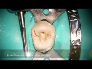 First Maxillary Premolar