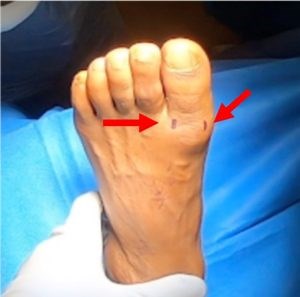 Hallux Rigidus - Treatment - Hip Arthroscopy & Foot & Ankle Surgery