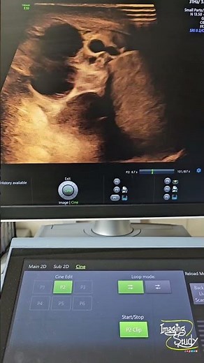 Epididymal & Intratesticular Cysts || Ultrasound