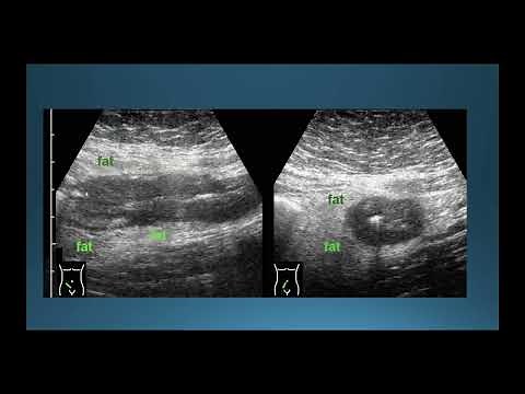 Ultrasound in Crohn's Disease