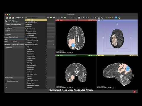 3D Slicer: Brain Tumor Segmentation using Deep learning