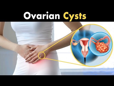 What is Ovarian Cysts? | Types, Causes and Symptoms