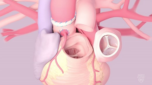 Mayo Clinic Ross procedure for the treatment of aortic valve disease - Mayo Clinic