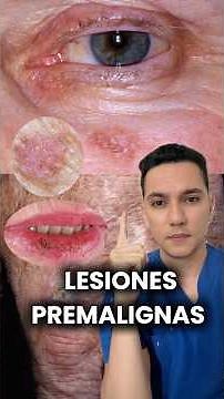 Actinic keratosis and actinic cheilitis: the most common premalignant skin lesions #dermatology