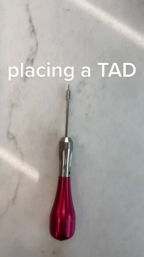 Understanding TAD: Temporary Anchorage Device in Orthodontics