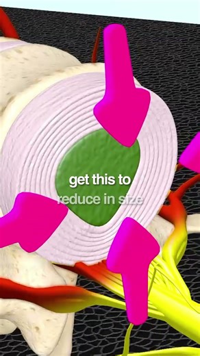 Beat Neck Pain: Real Relief From Disc Herniation—How Decompression Heals #neckpainrelief
