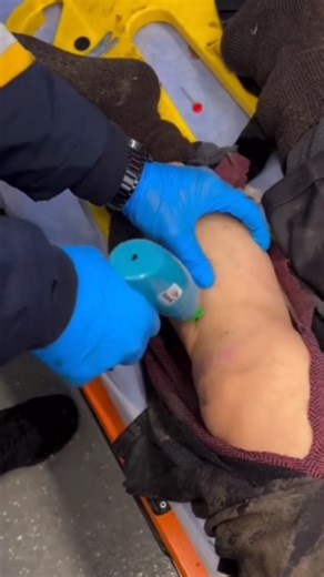 Uni Medical care on Instagram: "Intraosseous access (IO) is a critical medical procedure used in emergencies when peripheral or central venous access is difficult or impossible, allowing rapid administration of medications, fluids, or blood transfusions, especially in critically ill patients. 🟥🟥 It is indicated in cardiopulmonary arrest when venous access cannot be established within ninety seconds, providing a fast and effective route for life-saving medications. 🟥🟥 IO is also essential in 