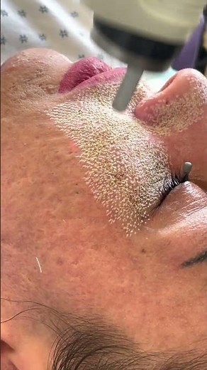 Fractional CO2 Laser Resurfacing