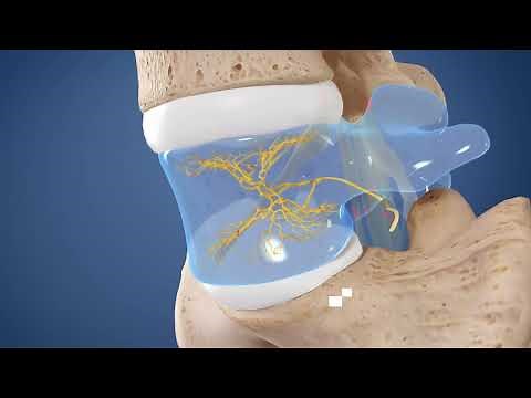 Intracept, Basivertebral Nerve Ablation at UK HealthCare