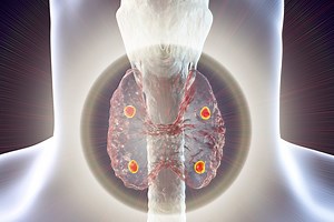 Can Hyperparathyroidism Be Cured Naturally? | Dr. Babak Larian