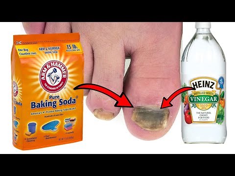 How to Cure Toenail Fungus: Can Vinegar Help?