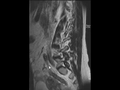 How to Read an MRI Scan of the Lumbar Spine - Lower Back (Part 2) | First Look MRI