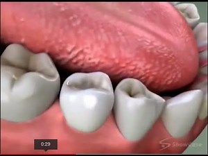 Porcelain Fused To Metal Crowns