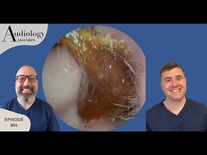 EAR WAX REMOVAL COMPILATION - EP814