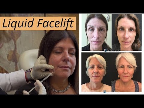 Liquid Facelifts [ Botox & Filler for a Non-Surgical Facelift ] #LiquidFacelift