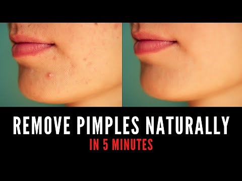 How To Remove Pimples Naturally At Home? | Remove Pimples In 5 Minutes | Skin Care | Voguenyog