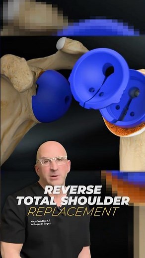 Shoulder Replacement Surgery: What You NEED To Know