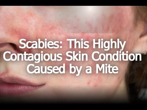 Scabies: This Highly Contagious Skin Condition Caused by a Mite