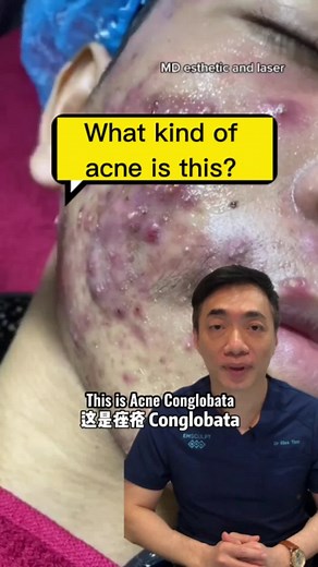 Understanding Acne Conglobata Treatment | Dr. Farma Skin