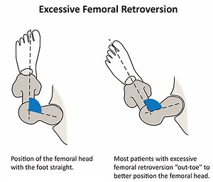 Femoral Retroversion: Causes, Symptoms and Treatments – Limb Lengthening