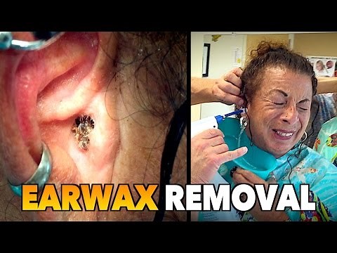 MASSIVE EARWAX REMOVAL! | Dr. Paul