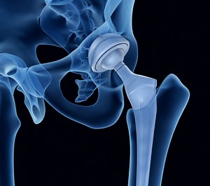 6 Important Long Term Precautions After Hip Replacement Surgery: Your Restrictions and Limitations While at Home