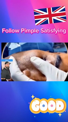Big Pimple blackheads removal #viral #pimple #satisfying #popping #acne #acnetreatment #relax #extractions