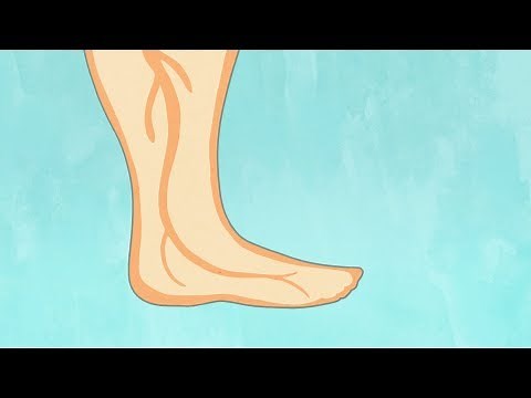 Pregnancy swelling (edema)
