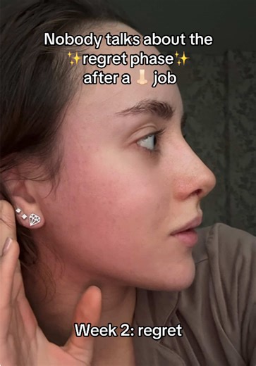 Rhinoplasty Journey: Week 2 vs Month 2 Insights