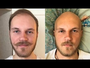 BALDING IN MY 20's Full Head Shave Transformation