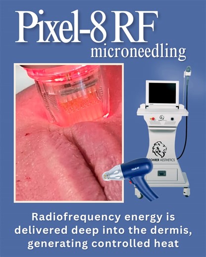 ✨ Pixel 8 RF microneedling ✨ This powerful treatment combines microneedling and radiofrequency to: • Tighten skin • Boost collagen • Smooth texture • Reduce fine lines and scars Want firmer, more youthful-looking skin? Book now and save an amazing $100 off your treatment. Sale pricing is: face and neck $599; eyes $399; neck and eyes $799. Minimal downtown and safe for all skin types. 📲 Text or call 575-762-4127 🌐 Online https://shorturl.at/RIaUC #RohrerAesthetics #Pixel8 #MedSpa #beauty #selfc