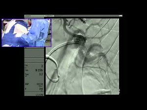 Transradial Embolization of a Splenic Artery Aneurysm - Part 2: Embolization - 10 min cut