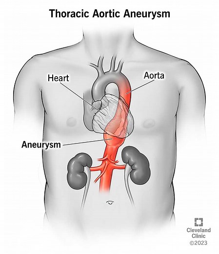 Thoracic Aortic Aneurysm: What You Need To Know