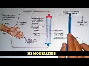 How To Hemodialysis Procedure Perform?