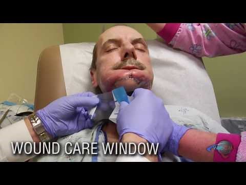 Wound Care Window- Oral Cutaneous Fistula