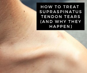 A Guide to Supraspinatus Tendon Tears (Rotator Cuff Injury)