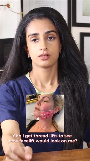 Can thread lift show facelift results?#threadlift #facelift