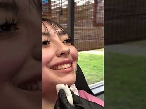 Lip filler demo on M-Shaped lips