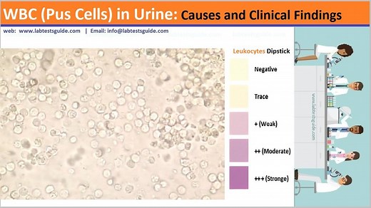 WBC (Pus Cells) in Urine | Lab Tests Guide