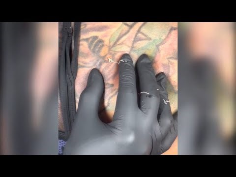 Satisfying Pimple Popping & Cyst Extractions -62