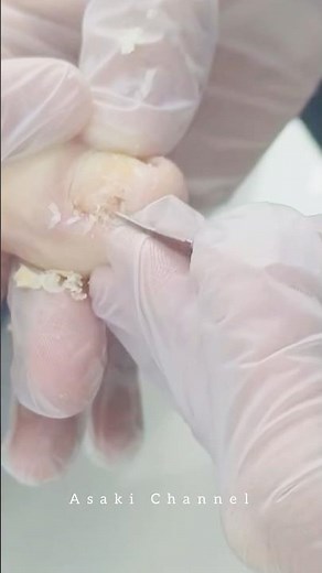 Safe and Effective Ingrown Toenail Removal by a Podiatrist