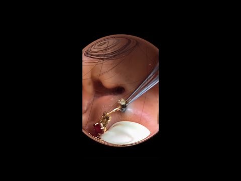 HUGE Blackhead Removal From EAR (Blackheads Removal Videos 2023)